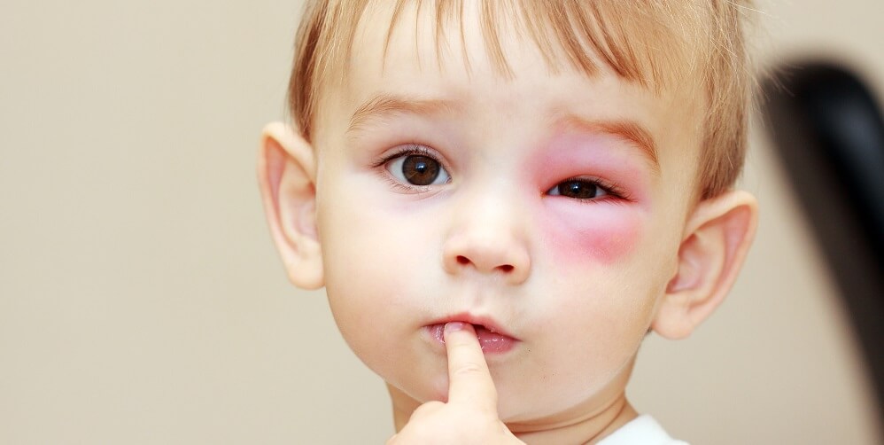 little boy stung by bumble bee around the eye