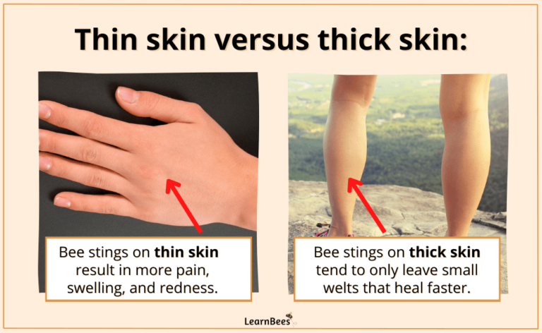 how-long-do-bee-stings-hurt-learnbees