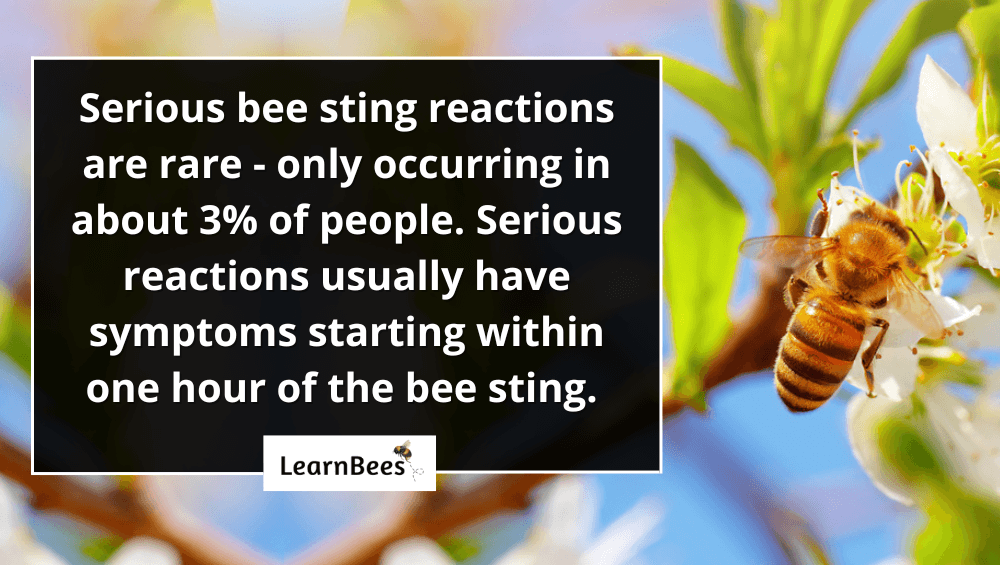 How Long Do Bee Stings Hurt