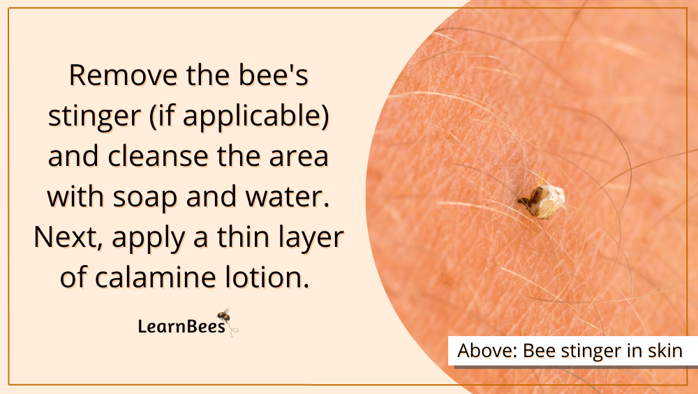 what to put in a bee sting