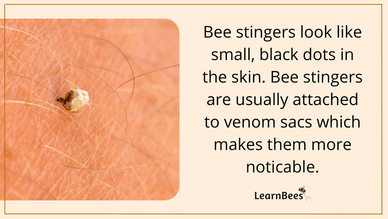 Bee stinger stuck under skin